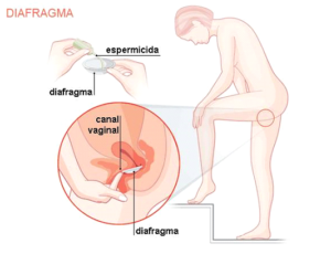 diafragma é outra alternativa de contracepção