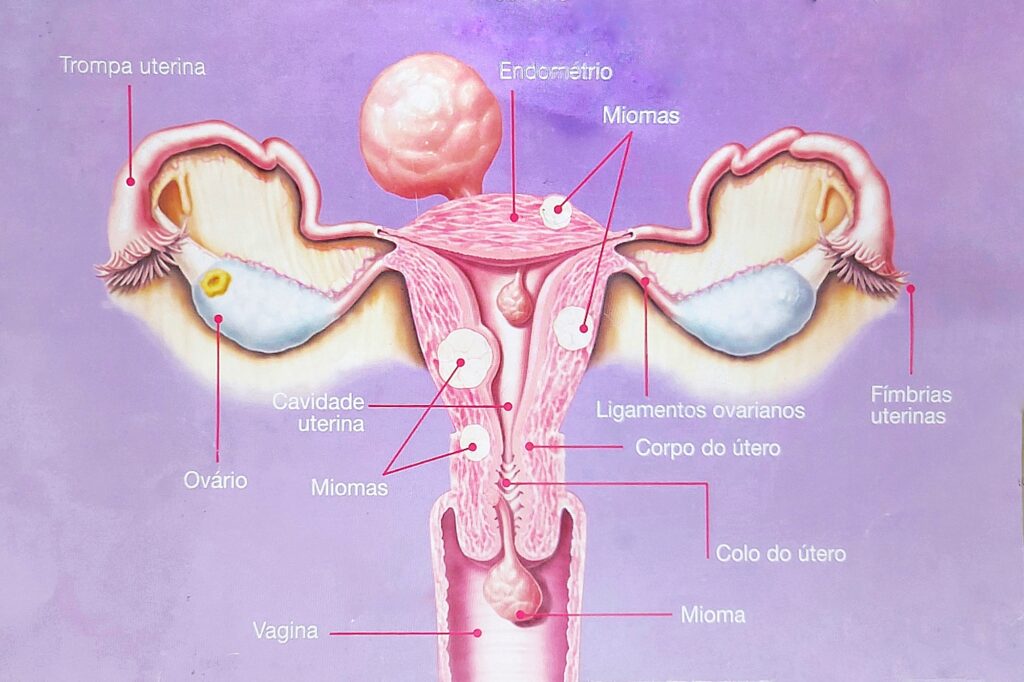 miomatose uterina ou miomas