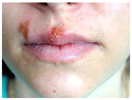 herpes_labial