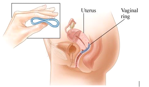 nuvaring é um anel contraceptivo