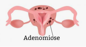 Adenomiose: o que é, sintomas e tratamento.